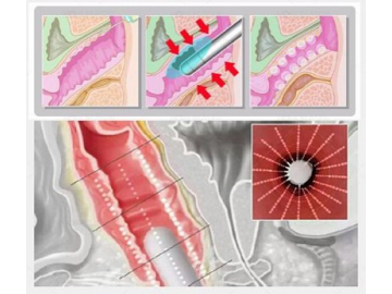 Aparelho de ultrasom focalizado HIFU para rejuvenescimento vaginal